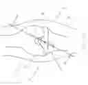 Fig. 29 - Method and Apparatus for Fixing a Graft in a Bone Tunnel