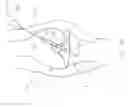 Fig. 30 - Method and Apparatus for Fixing a Graft in a Bone Tunnel