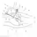 Fig. 32 - Method and Apparatus for Fixing a Graft in a Bone Tunnel