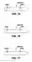 Fig. 50 - Method and Apparatus for Fixing a Graft in a Bone Tunnel
