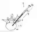 Fig. 01 - Filler Means, Feeding Device and Method for the Forming of a Support Structure in a Bone Cavity