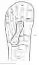 Fig. 01 - SHOE APPLIANCE WITH AN ORTHOPEDIC DEVICE