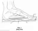 Fig. 02 - SHOE APPLIANCE WITH AN ORTHOPEDIC DEVICE