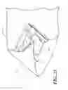 Fig. 22 - Catheter tray, packaging system, instruction insert, and associated methods