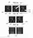 Fig. 11 - ITERATIVE VASCULAR RECONSTRUCTION BY REALIGNMENT