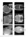 Fig. 08 - Techniques for tomographic image by background subtraction