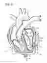 Fig. 06 - METHOD OF TREATING CORONARY ARTERIES WITH PERIVASCULAR DELIVERY OF THERAPEUTIC AGENTS