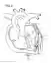 Fig. 07 - METHOD OF TREATING CORONARY ARTERIES WITH PERIVASCULAR DELIVERY OF THERAPEUTIC AGENTS