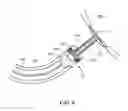 Fig. 06 - Implantable Inner Ear Drive System