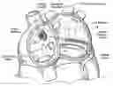 Fig. 01 - Devices, systems, and methods for reshaping a heart valve annulus, including the use of a bridge implant having an adjustable bridge stop