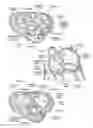 Fig. 03 - Devices, systems, and methods for reshaping a heart valve annulus, including the use of a bridge implant having an adjustable bridge stop