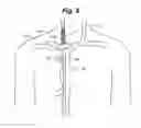 Fig. 07 - Central venous access system