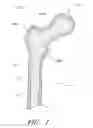 Fig. 02 - PROXIMAL FEMUR FIXATION APPARATUS, SYSTEMS AND METHODS WITH ANGLED ELONGATE ELEMENTS