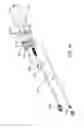 Fig. 07 - KNEE RECONSTRUCTION PROCEDURE AND SURGICAL IMPLEMENT PARTICULARLY USEFUL FOR SUCH KNEE RECONSTRUCTION PROCEDURE