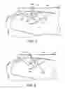 Fig. 06 -  SURGICAL MESH AND METHOD OF MANUFACTURE