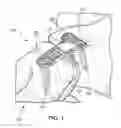 Fig. 02 - TABBED COMPRESSION PLATE AND METHOD OF USE