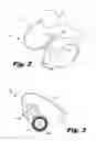 Fig. 03 - Cochlear lead