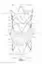Fig. 02 - BLOUSED STENT-GRAFT AND FENESTRATION METHOD