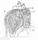 Fig. 01 - Allogenic Articular Cavity Prosthesis and Method for Implanting the Same