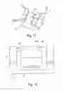 Fig. 06 - Allogenic Articular Cavity Prosthesis and Method for Implanting the Same