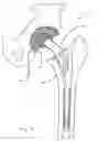 Fig. 02 - Bimetal acetabular component construct for hip joint prosthesis