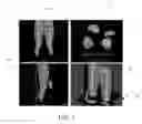 Fig. 02 - METHODS AND SYSTEMS OF INTEGRATED SIMULATIONS FOR PATIENT-SPECIFIC BODY EMBEDDED WITH MEDICAL IMPLANTS