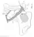 Fig. 22 - Sacrocolpopexy support and method of implantation