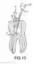 Fig. 07 - Apparatus and method for root canal obturation
