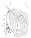 Fig. 01 - Dialysis catheter