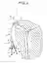 Fig. 07 - Dialysis catheter