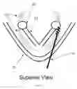 Fig. 04 - Methods and devices for arytenoid repositioning
