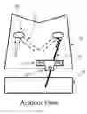 Fig. 05 - Methods and devices for arytenoid repositioning