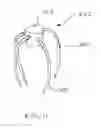 Fig. 08 - Closing openings in anatomical tissue