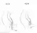 Fig. 06 - ANAL PROLAPSE PREVENTION AID