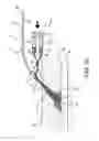 Fig. 07 - Apparatus and methods for sealing a puncture in tissue