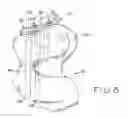 Fig. 04 - Bone fracture fixation system