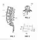 Fig. 02 - INTERSPINOUS DEVICE AND METHOD OF IMPLANTING