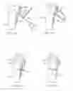 Fig. 28 - System for Treating Bone Fractures