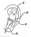 Fig. 01 - APPARATUS AND METHOD OF ANCHORING AN EAR PIECE