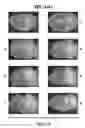 Fig. 69 - Methods for treating conditions associated with MASP-2 dependent complement activation