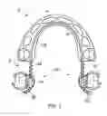 Fig. 02 - Orthodontic Space Closing Appliances