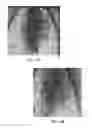 Fig. 28 - Subxyphoid epicardial ablation