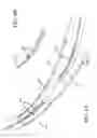 Fig. 05 - Devices, systems, and methods for organ retroperfusion