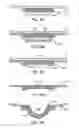 Fig. 09 - Dual modulus balloon for interventional procedures