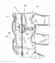 Fig. 01 - SUTURE BUCKLE WITH SELECTIVE FRICTION