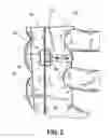 Fig. 03 - SUTURE BUCKLE WITH SELECTIVE FRICTION