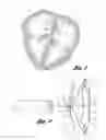Fig. 02 - Closure device with string retractable umbrella and method for closing a body opening with the same