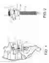 Fig. 02 - System for percutaneously fixing a connecting rod to a spine
