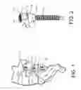 Fig. 02 - Surgical instrument and method for the distraction or compression of bones