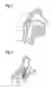Fig. 02 - Cardiovertor/defibrillator